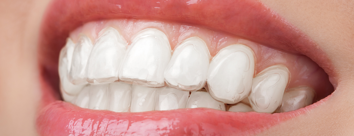 Nova Geração de Alinhadores em Ortodontia – Mais Rápido e Invisível – Orthoi